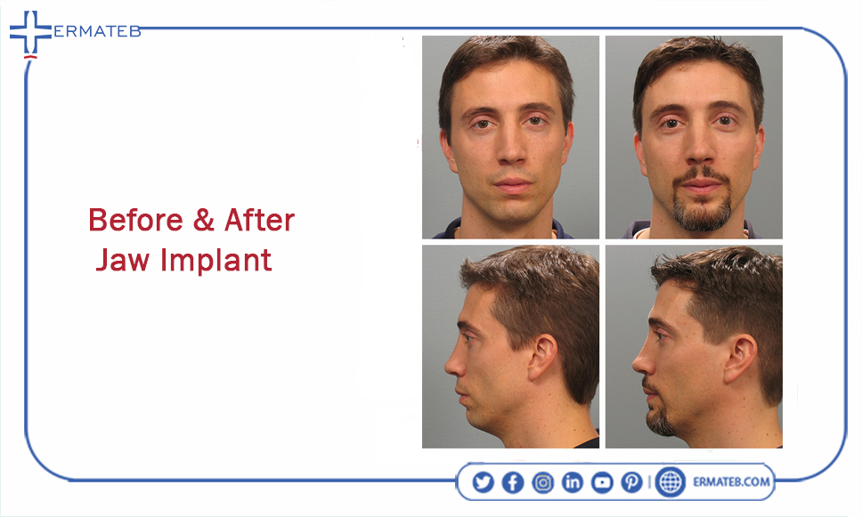 before and after jaw implant
